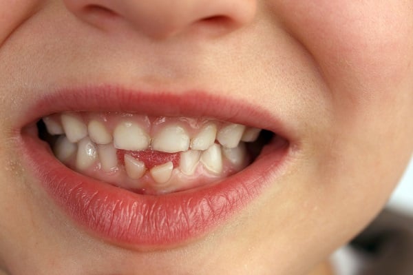 Foto - Siz siz olun sakın atmayın! Süt dişlerinin bu faydasına inanamayacaksınız