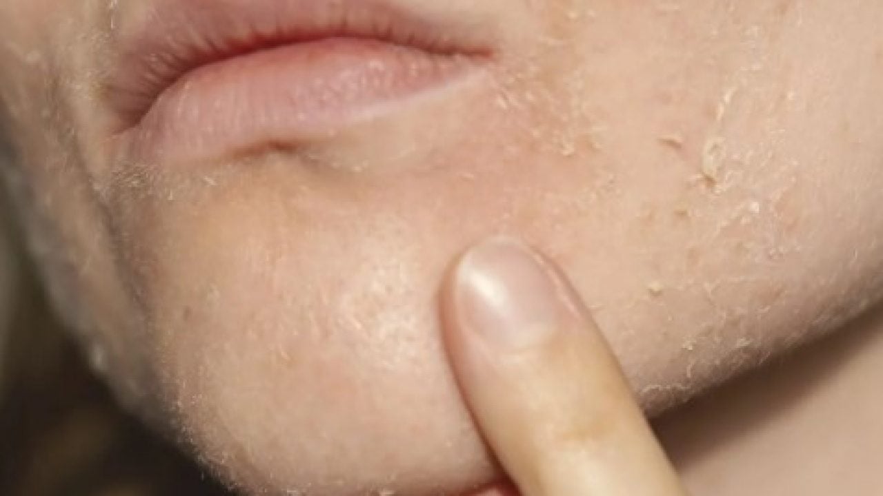 Foto - Soğuk havalarda cildiniz için büyük tehlike! Uzmanlar uyarıyor