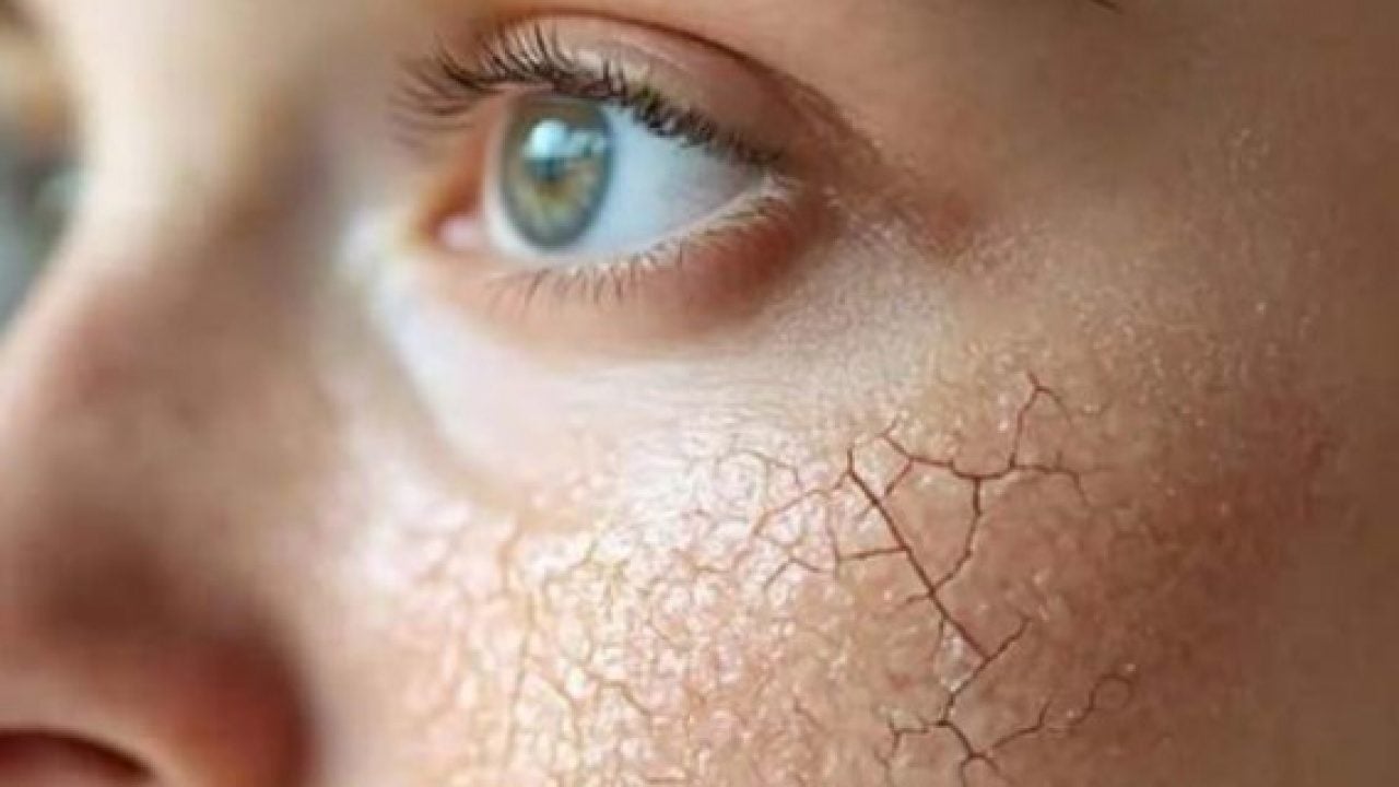 Foto - Soğuk havalarda cildiniz için büyük tehlike! Uzmanlar uyarıyor