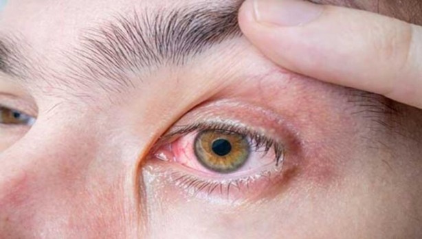 Foto - Soğuk kuru göz hastalığını tetikliyor