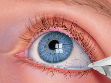 Foto - Soğuk kuru göz hastalığını tetikliyor