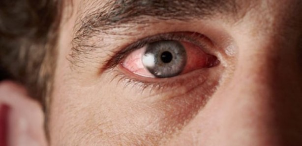 Soğuk kuru göz hastalığını tetikliyor