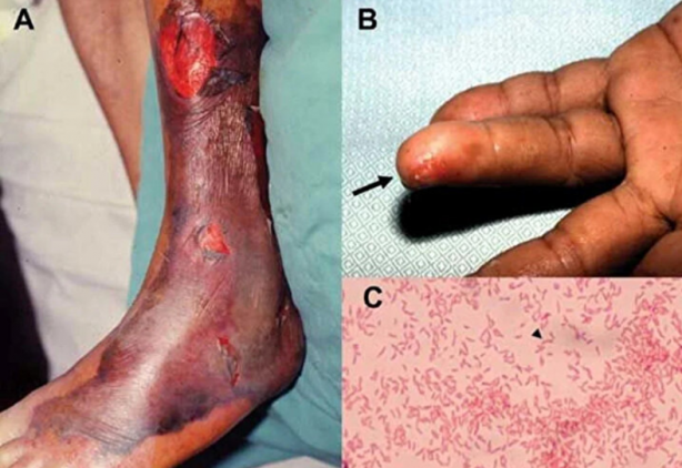 Foto - Şoke eden haber! Et yiyen bakteri alarmı