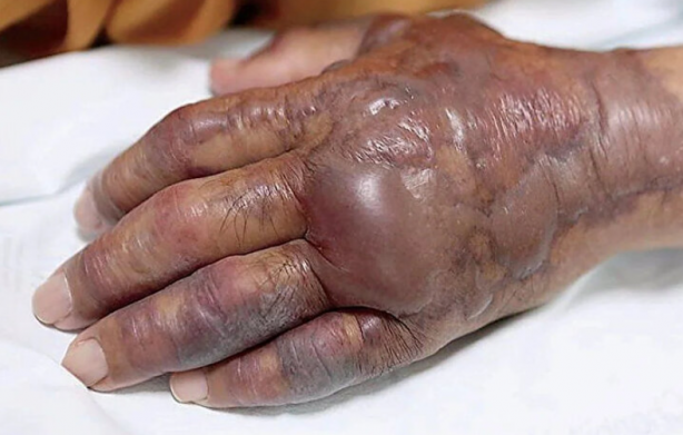 Foto - Şoke eden haber! Et yiyen bakteri alarmı