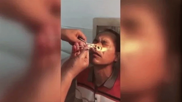 Foto - Şoke eden olay! Kanayan burnundan çıkanlar şaşkına çevirdi