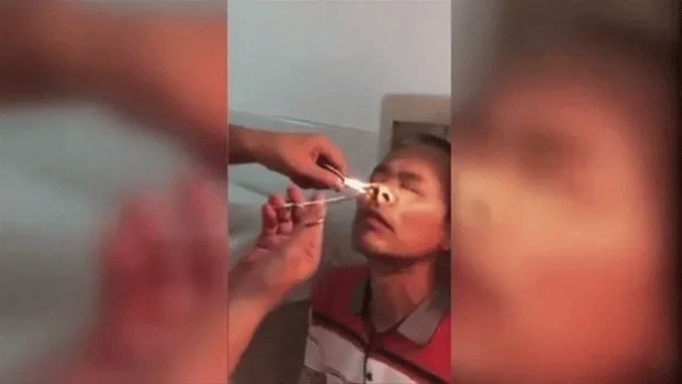 Foto - Şoke eden olay! Kanayan burnundan çıkanlar şaşkına çevirdi