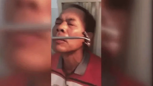 Foto - Şoke eden olay! Kanayan burnundan çıkanlar şaşkına çevirdi