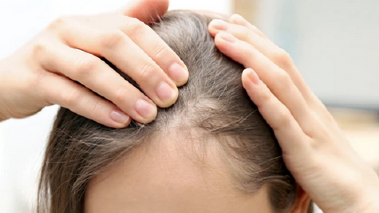 Foto - Stres kaynaklı saç dökülmesine bu çay ile dur de! Süper bir içecek! Saç dökülmesine basit çözümler!