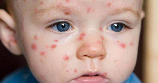 Foto - Su çiçeği sonrası o sendroma dikkat!