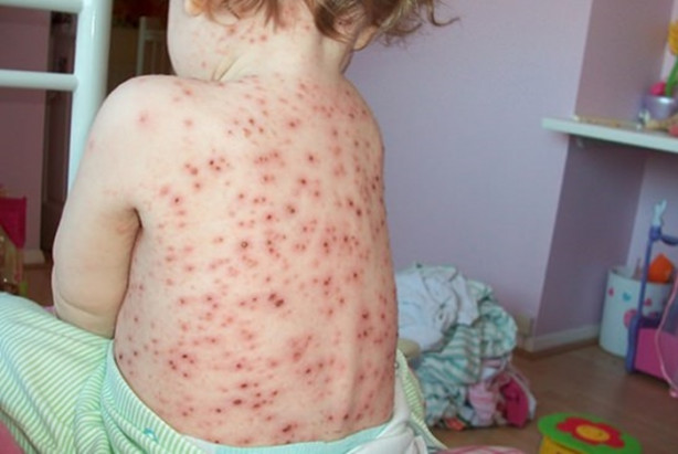 Foto - Su çiçeği sonrası o sendroma dikkat!