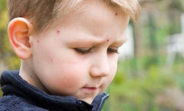 Foto - Su çiçeği sonrası o sendroma dikkat!