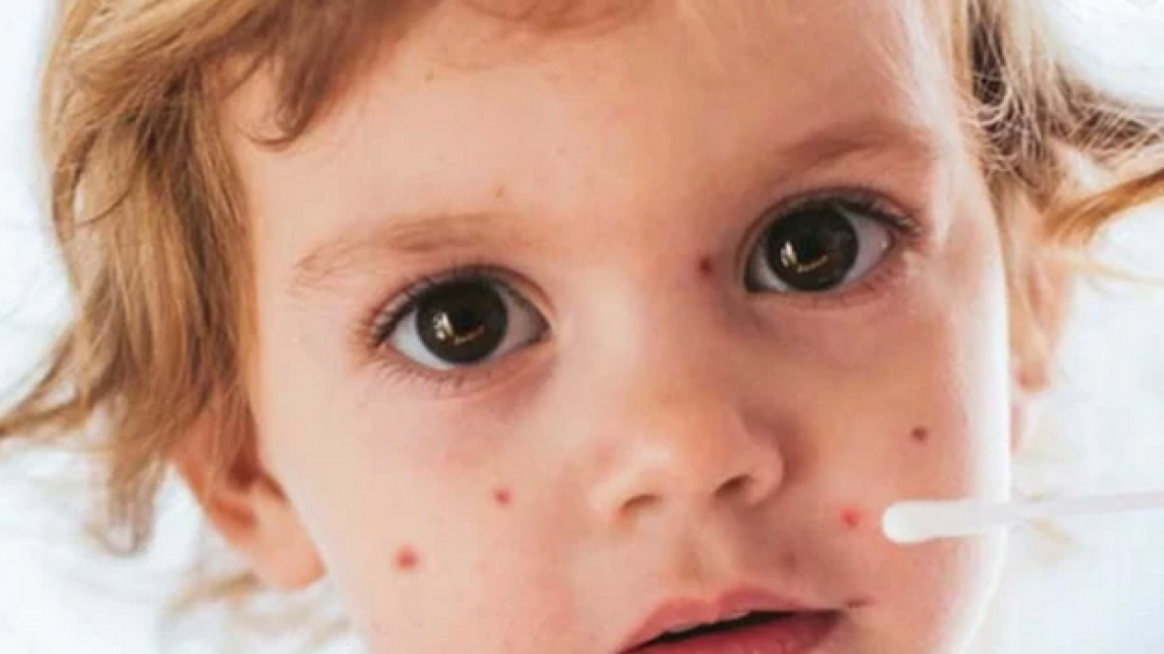 Su çiçeği virüsü yıllar sonra neden uyanıyor? Ortaya çıkan bir enfeksiyon ve...