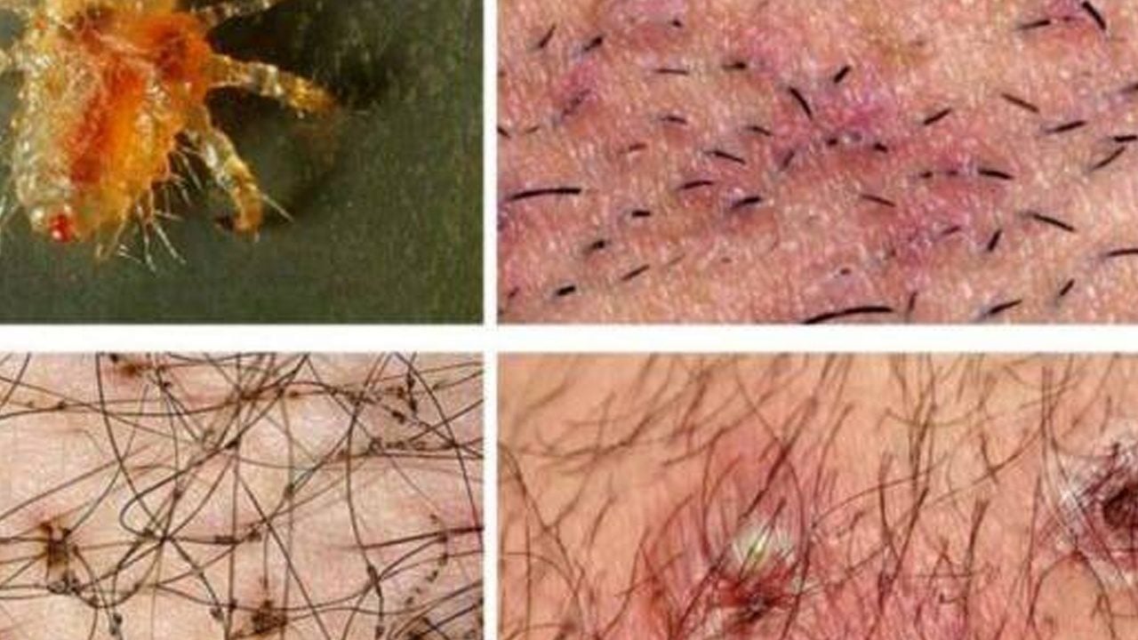 Foto - Süper bit tedavisinde en büyük hata: İlaçlara direnç geliştiriyor! İnanan insanlar yandı, sakın güvenmeyin