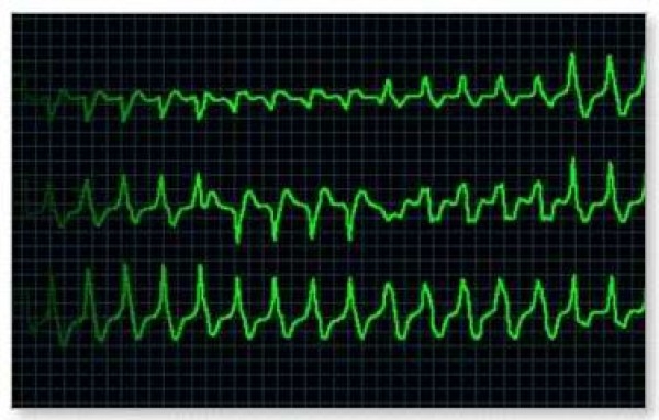 Foto - Sürekli çikolata yemek istemek o eksikliğin işareti!