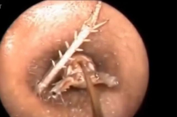 Foto - Talihsiz adamın kulağından böcek çıkarıldı!