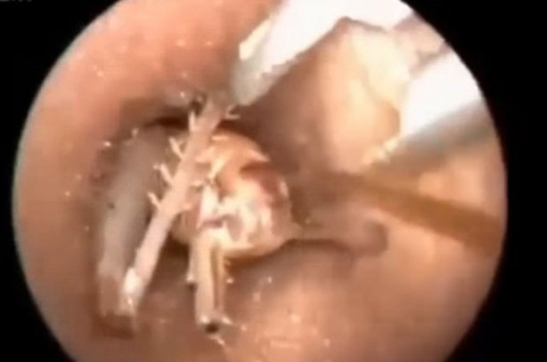 Foto - Talihsiz adamın kulağından böcek çıkarıldı!