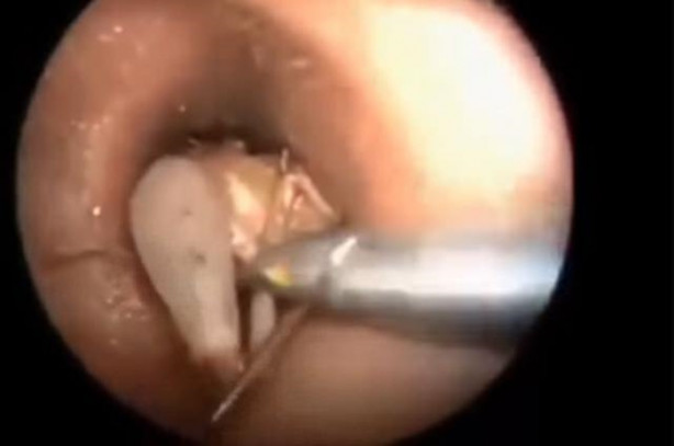 Foto - Talihsiz adamın kulağından böcek çıkarıldı!