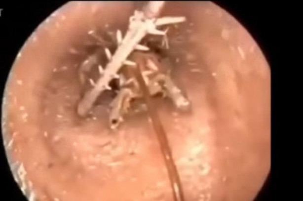 Foto - Talihsiz adamın kulağından böcek çıkarıldı!