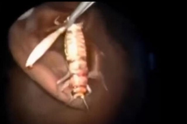 Foto - Talihsiz adamın kulağından böcek çıkarıldı!