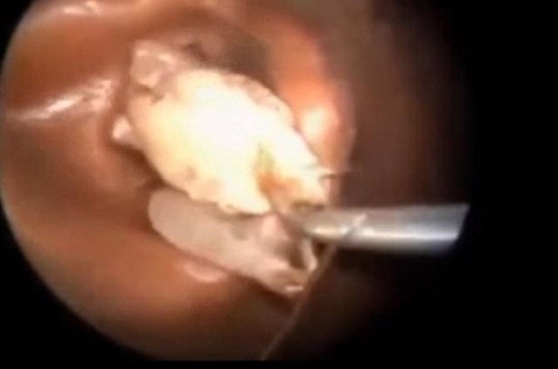 Foto - Talihsiz adamın kulağından böcek çıkarıldı!