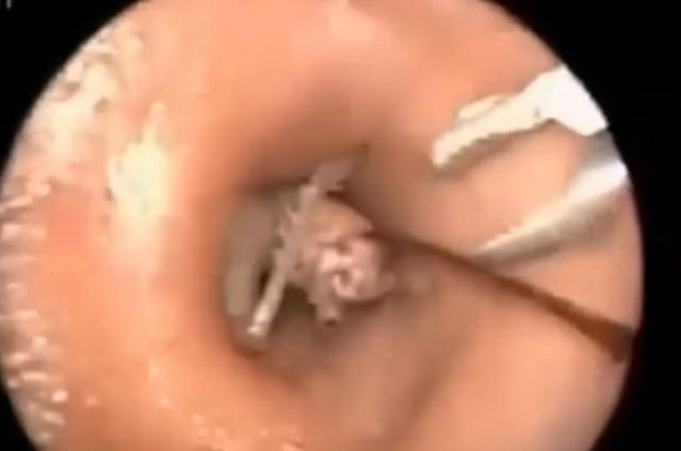 Foto - Talihsiz adamın kulağından böcek çıkarıldı!