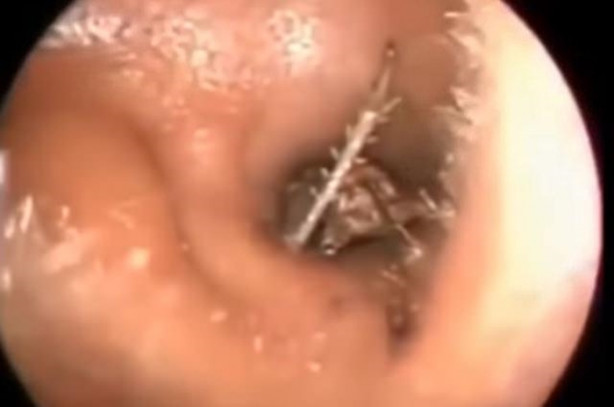 Foto - Talihsiz adamın kulağından böcek çıkarıldı!