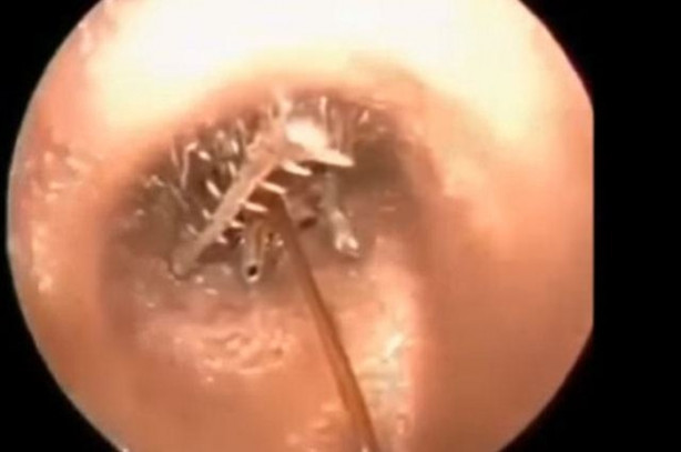 Foto - Talihsiz adamın kulağından böcek çıkarıldı!