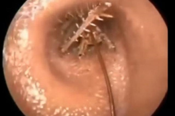 Foto - Talihsiz adamın kulağından böcek çıkarıldı!