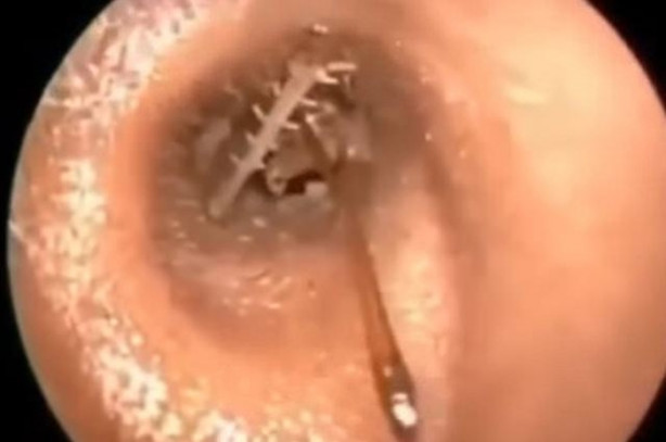 Foto - Talihsiz adamın kulağından böcek çıkarıldı!