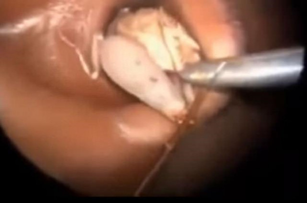 Foto - Talihsiz adamın kulağından böcek çıkarıldı!