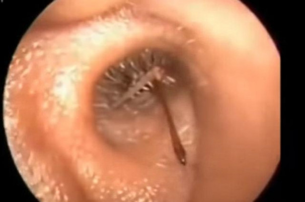 Talihsiz adamın kulağından böcek çıkarıldı!