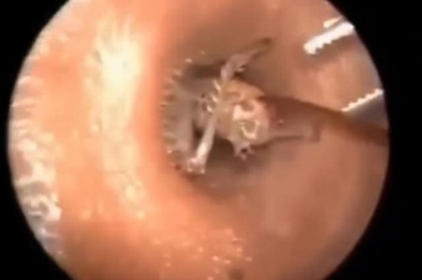 Foto - Talihsiz adamın kulağından böcek çıkarıldı!