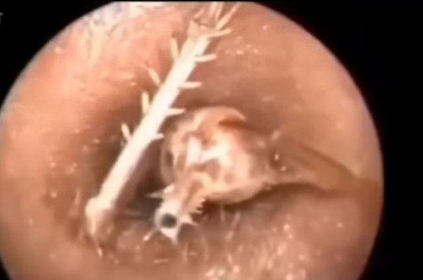 Foto - Talihsiz adamın kulağından böcek çıkarıldı!