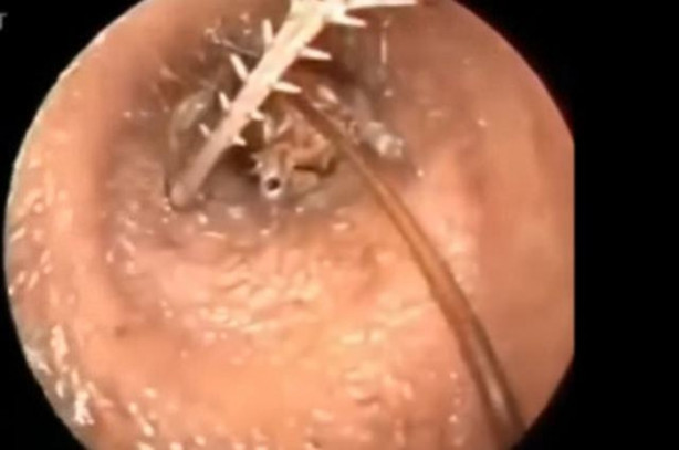 Foto - Talihsiz adamın kulağından böcek çıkarıldı!