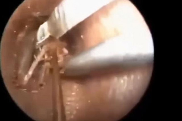 Foto - Talihsiz adamın kulağından böcek çıkarıldı!