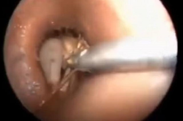 Foto - Talihsiz adamın kulağından böcek çıkarıldı!