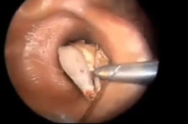 Foto - Talihsiz adamın kulağından böcek çıkarıldı!