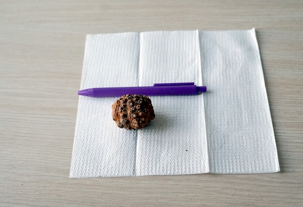 Foto - Tam 9 sene böyle yaşadı! Doktorlar bile gözlerine inanamadı