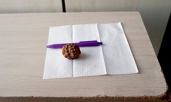 Foto - Tam 9 sene böyle yaşadı! Doktorlar bile gözlerine inanamadı