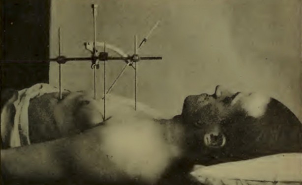 Foto - Tarihte kullanılan korkunç tıp ekipmanları