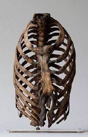 Foto - Tarihte kullanılan korkunç tıp ekipmanları