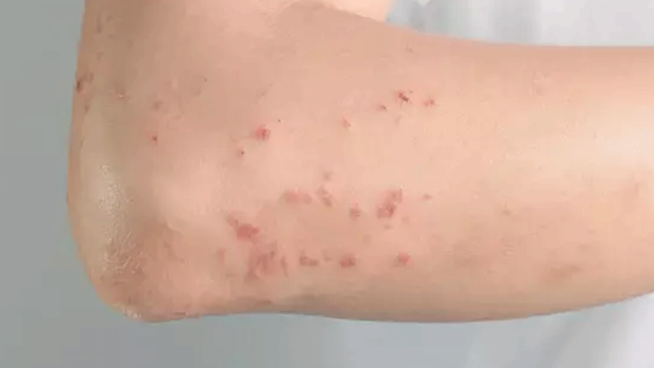 Foto - Tatil bölgelerinde bu belirtilere dikkat: Vakalarda patlama var!