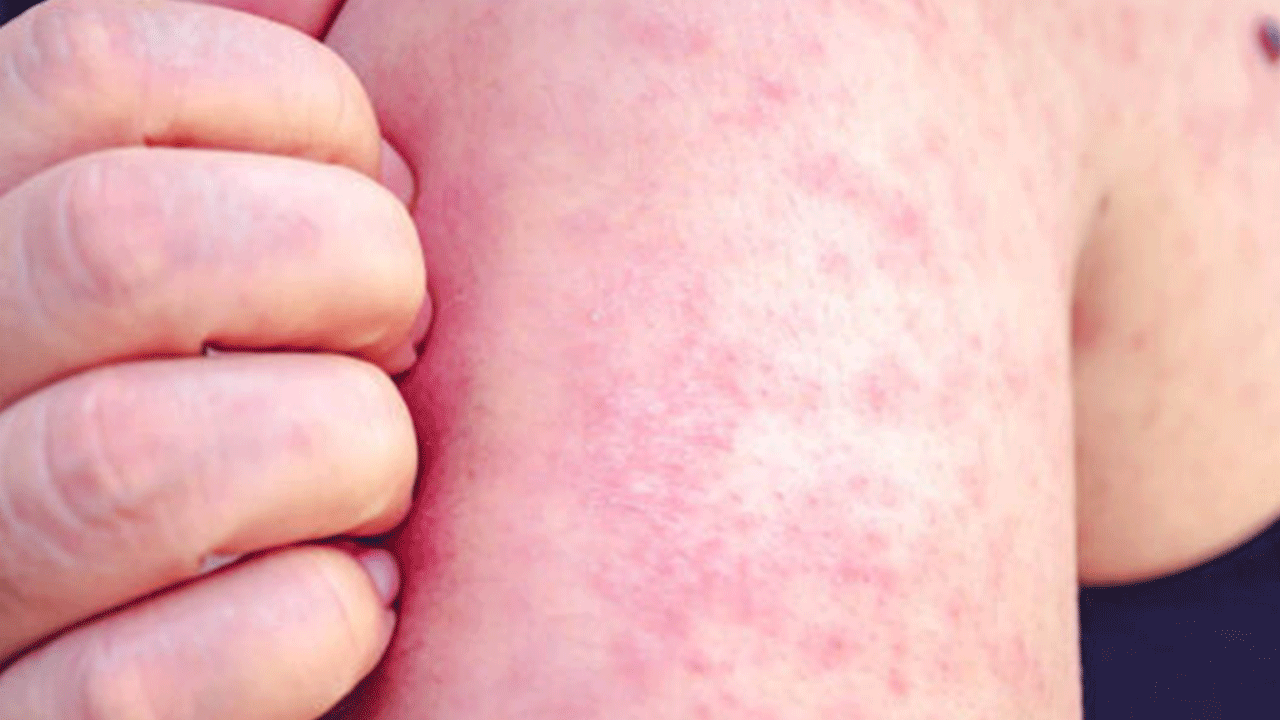 Foto - Tatil bölgelerinde bu belirtilere dikkat: Vakalarda patlama var!