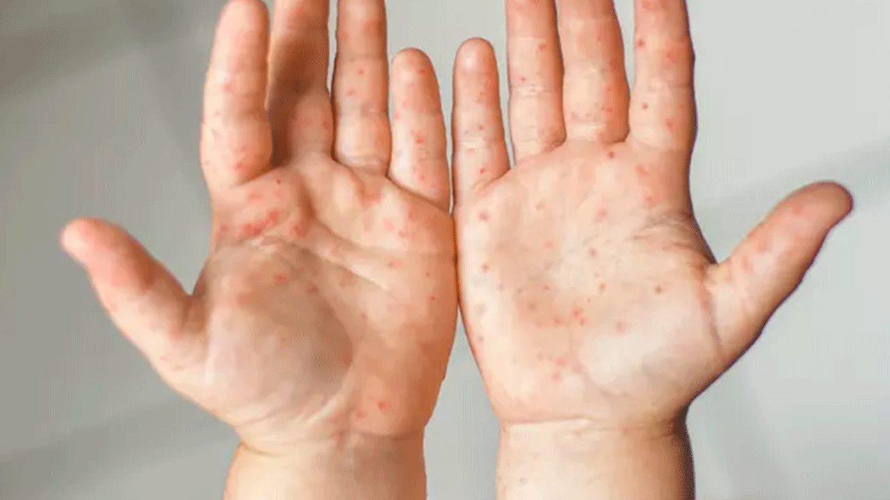 Foto - Tatil bölgelerinde bu belirtilere dikkat: Vakalarda patlama var!