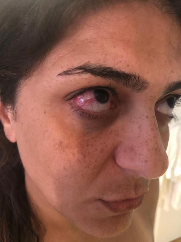 Foto - Tatilde bu hastalığa dikkat!