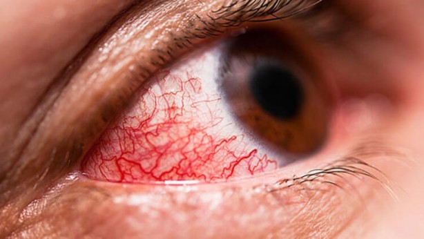 Foto - Tatilde bu hastalığa dikkat!