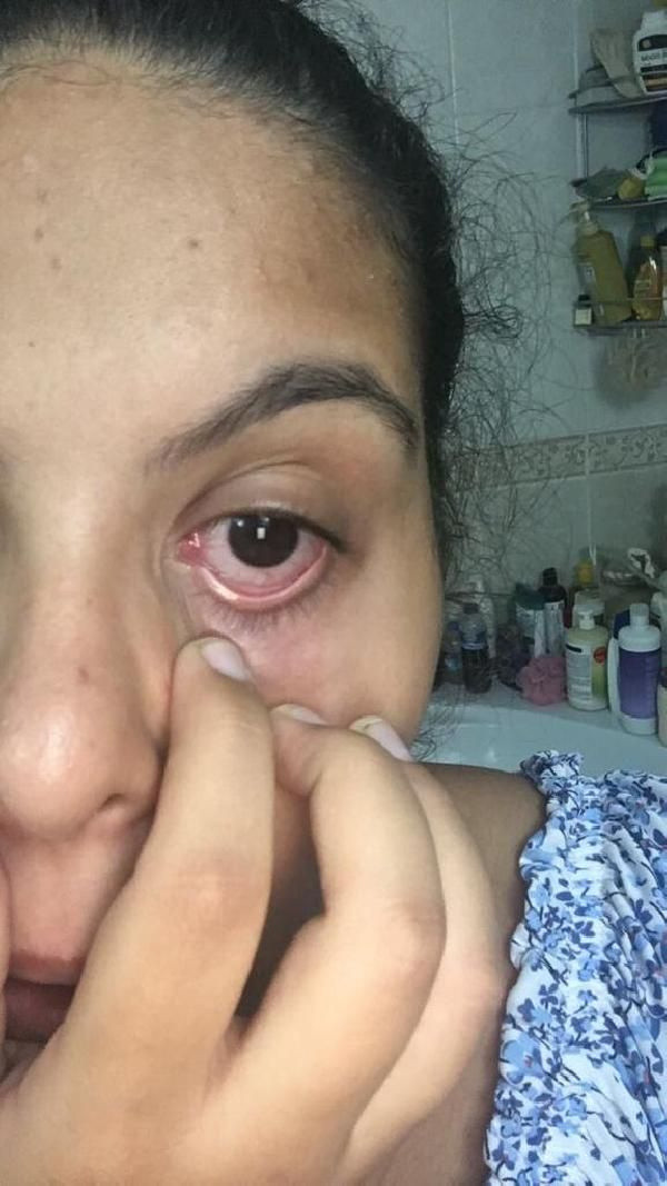 Foto - Tatilde bu hastalığa dikkat!