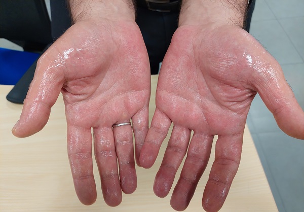 Foto - Terleme deyip geçmeyin! Bu belirtiler varsa hemen doktora gitmelisiniz