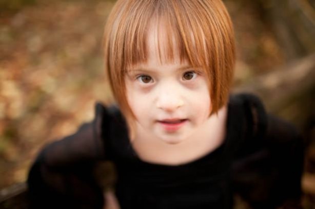 Foto - 21 adımda down sendromu 