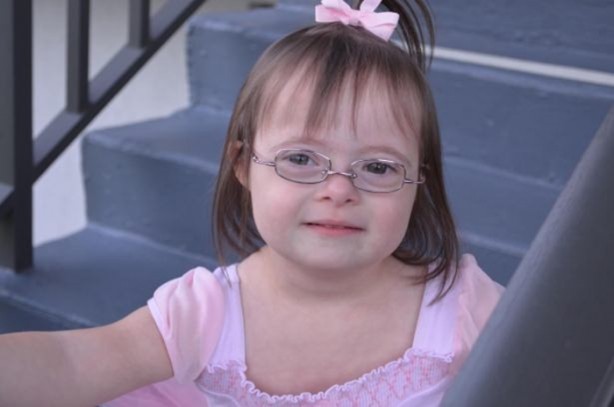 Foto - 21 adımda down sendromu 